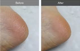 Смягчающий крем для ног с мочевиной DERMA-B Urea 9.8 Foot Cream, 80 мл MO1396 фото