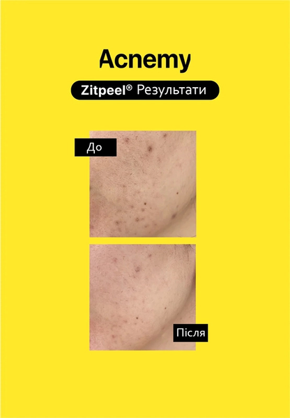 Кислотный несмываемый пилинг для кожи, склонной к акне Acnemy ZITPEEL M00026 фото