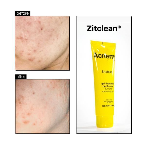 Очищающий гель для кожи с акне Acnemy Zitclean, 150 мл M00029 фото